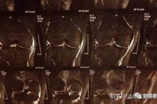 巴萨官宣德容伤情：右膝内侧副韧带撕裂 恐长期缺阵